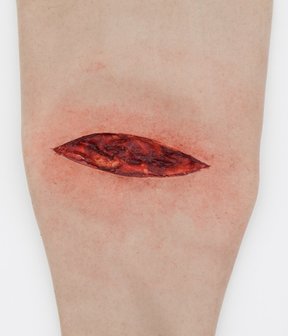Simsleeve lower arm stab wound
