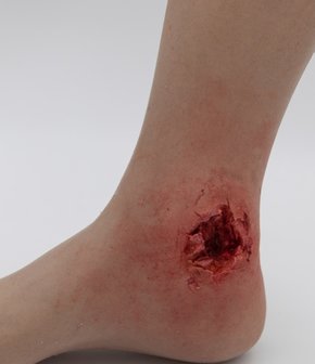 Slimsleeve ankle gunshot wound