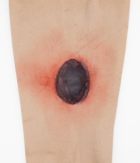 Simsleeve onderbeen ernstige Ulcer