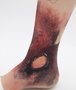 Simsleeve ankle full thickness burns