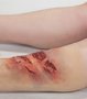 Simsleeve onderbeen meerdere verwondingen