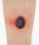Simsleeve lower leg extreme Ulcer